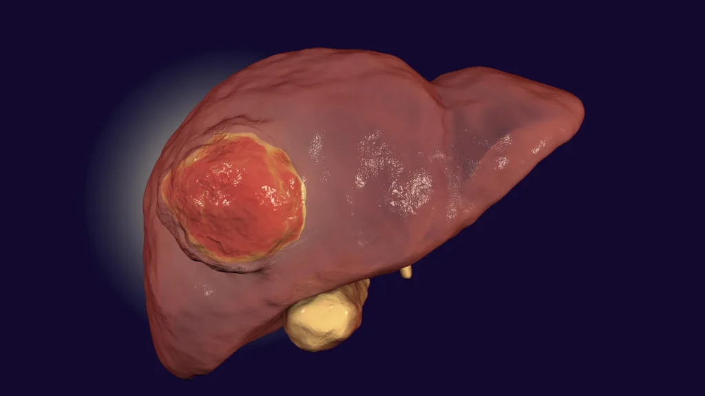 FDA-approved drug may finally help immunotherapy defeat rare liver cancer FDA-approved drug may finally help immunotherapy defeat rare liver cancer