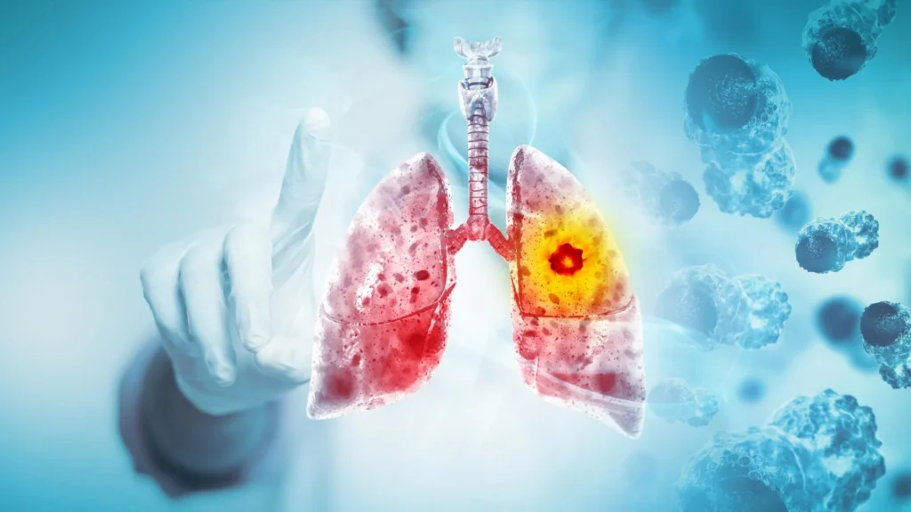 Why are healthy young non-smokers developing lung cancer? Why are healthy young non-smokers developing lung cancer?