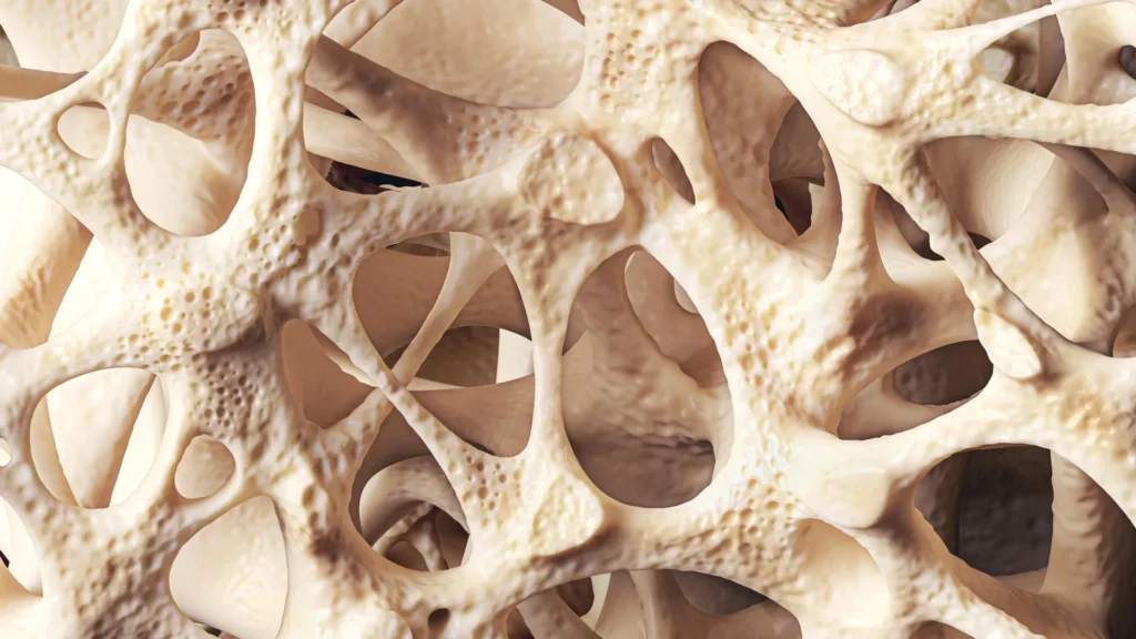 Osteopenia is silently weakening bones in millions of people Osteopenia is silently weakening bones in millions of people