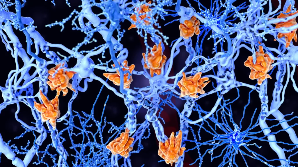 These fat-filled brain cells may be making multiple sclerosis worse These fat-filled brain cells may be making multiple sclerosis worse