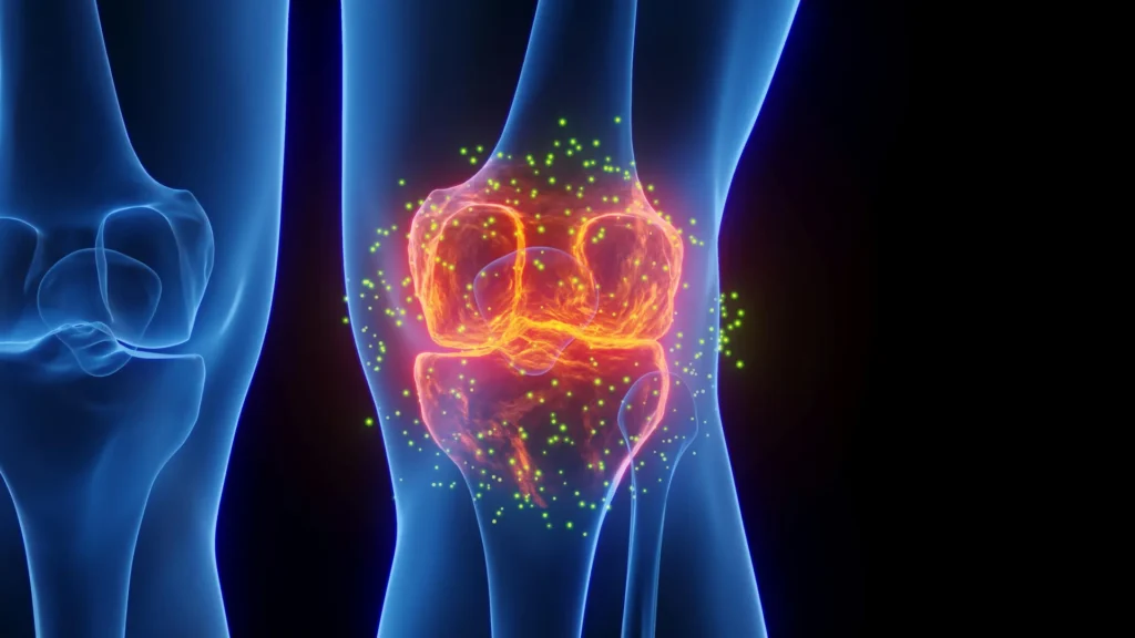 This emerging treatment is helping people avoid knee replacement surgery This emerging treatment is helping people avoid knee replacement surgery