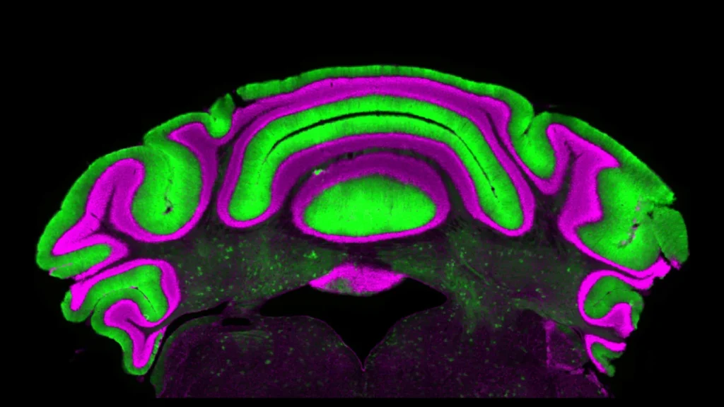 A surprising brain discovery is forcing scientists to rethink movement disorders A surprising brain discovery is forcing scientists to rethink movement disorders
