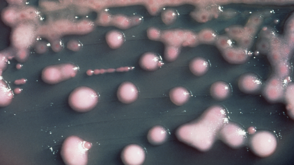 A woman got a UTI. Two years later, the bacteria had evolved, invaded her brain. A woman got a UTI. Two years later, the bacteria had evolved, invaded her brain.