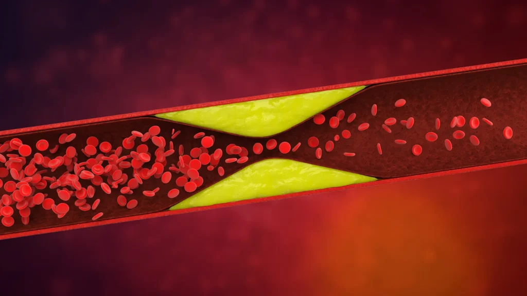 Hidden in your dna: The mutation combo that raises clot risk by 180% Hidden in your dna: The mutation combo that raises clot risk by 180%