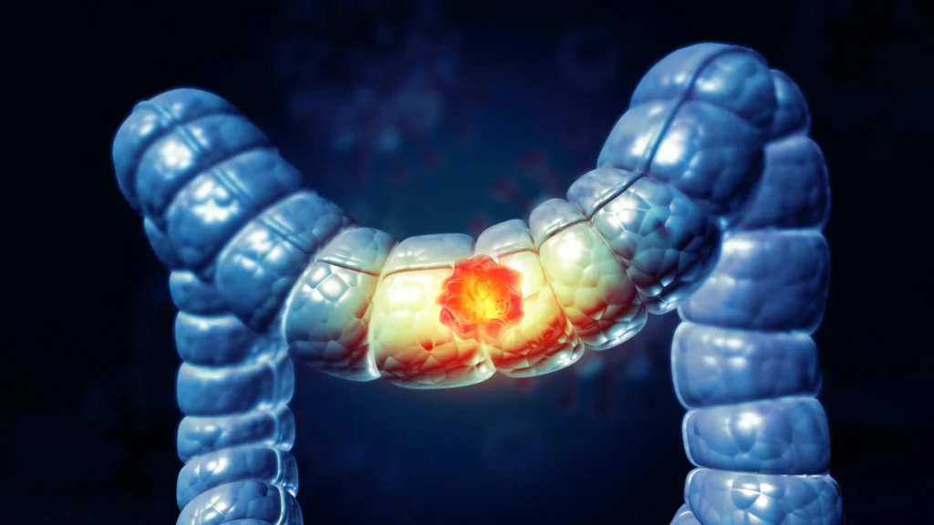 Why colorectal cancer breaks the immune system’s rules Why colorectal cancer breaks the immune system’s rules