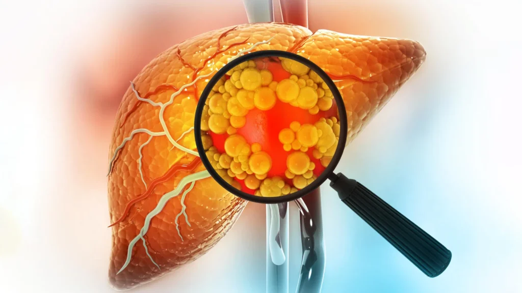 Experimental drug reverses severe fatty liver disease by repairing the gut Experimental drug reverses severe fatty liver disease by repairing the gut