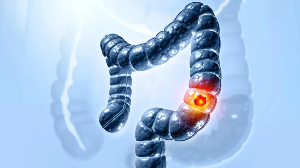 Scientists finally solved how a common gut bacterium triggers colon cancer Scientists finally solved how a common gut bacterium triggers colon cancer