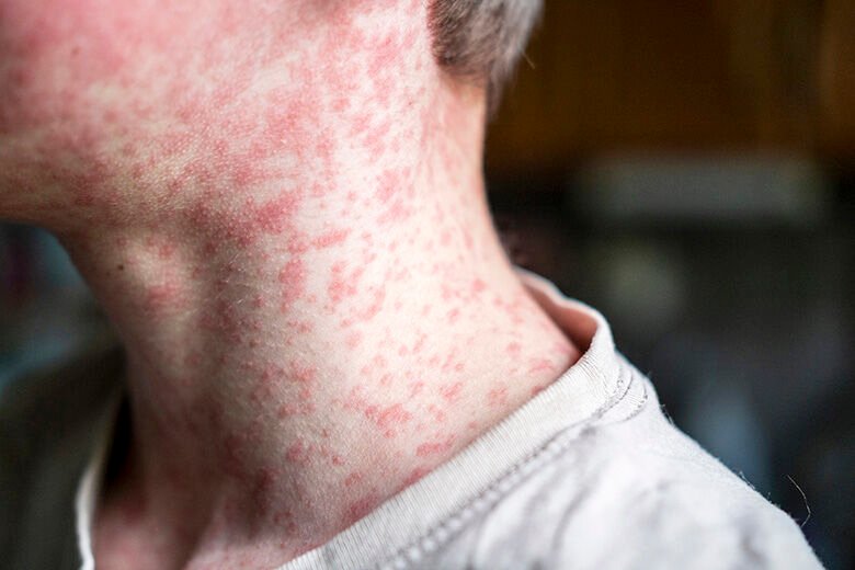 Maryland confirms 3 new measles cases, warns of possible exposures Maryland confirms 3 new measles cases, warns of possible exposures