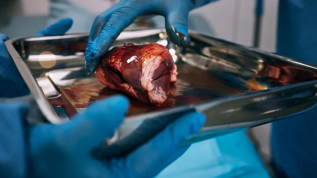 Nearly half of kidney transplant patients never even get started Nearly half of kidney transplant patients never even get started