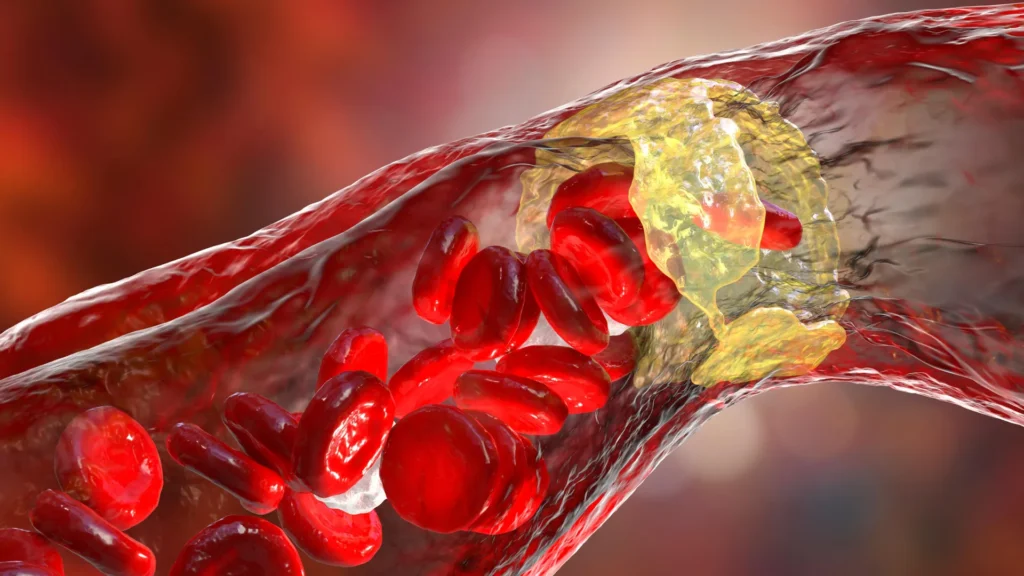 Powerful cholesterol drug cuts heart attack risk by 31% Powerful cholesterol drug cuts heart attack risk by 31%