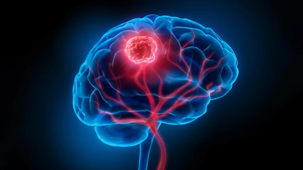 Simple supplement mix shows remarkable results in brain cancer Simple supplement mix shows remarkable results in brain cancer