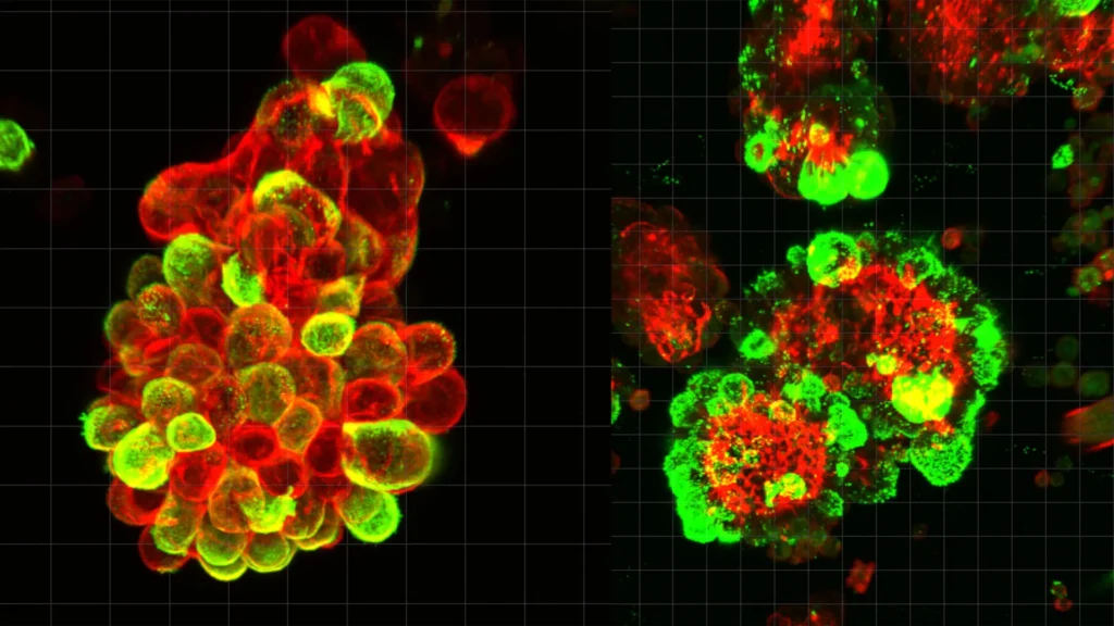 A secret cell alliance may explain why ovarian cancer is so deadly A secret cell alliance may explain why ovarian cancer is so deadly