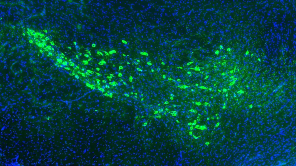 Yale scientists may have found how Parkinson’s disease spreads through the brain Yale scientists may have found how Parkinson’s disease spreads through the brain
