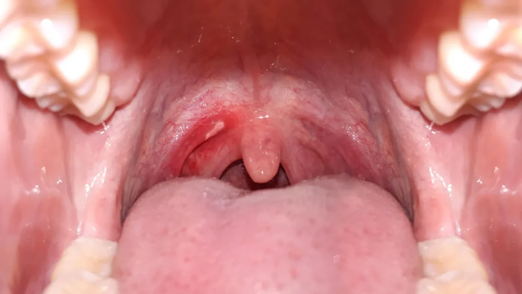 Even one drink a day may raise mouth cancer risk Even one drink a day may raise mouth cancer risk