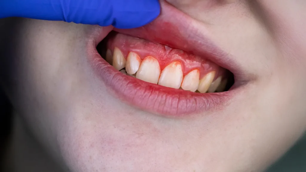 Scientists discover a hidden heart valve risk linked to gum disease Scientists discover a hidden heart valve risk linked to gum disease