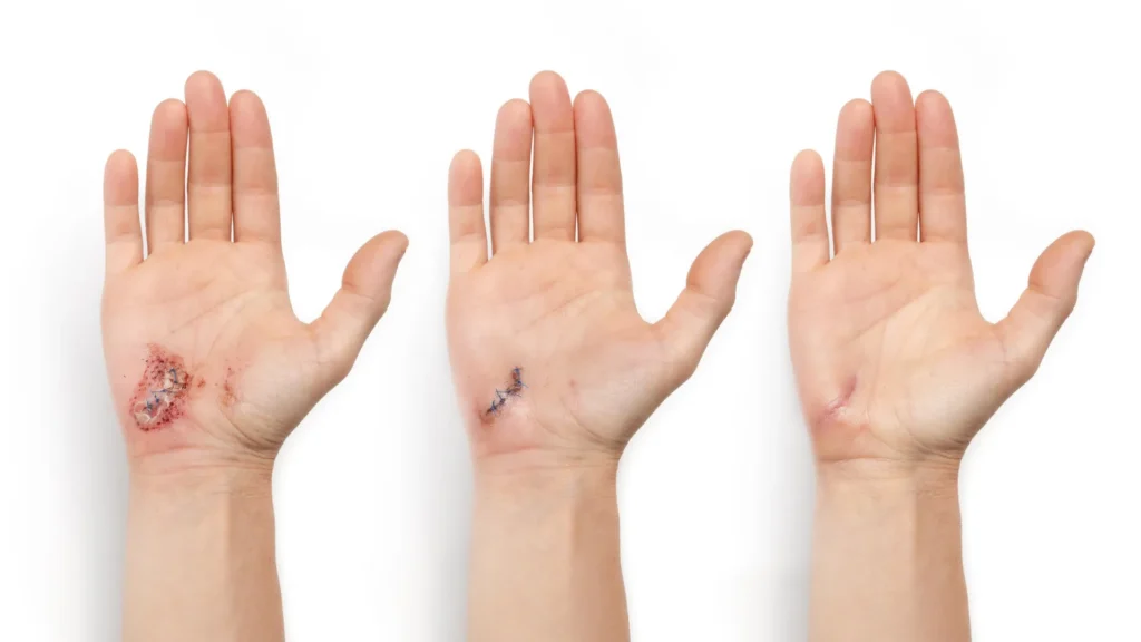AI-powered smart bandage heals wounds 25% faster AI-powered smart bandage heals wounds 25% faster