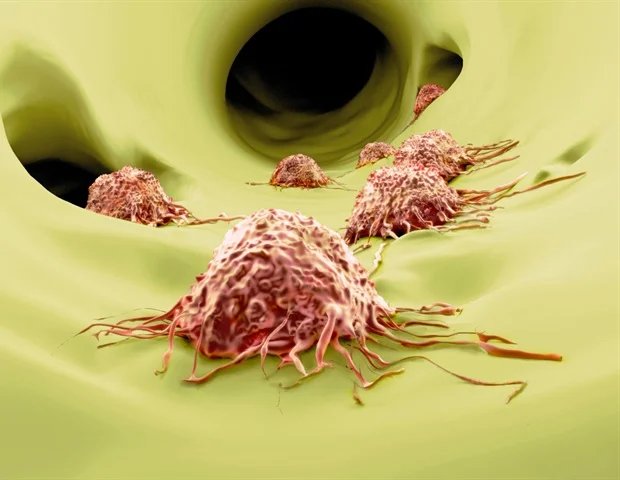AI-based methods help uncover hidden roots of tumor metastasis AI-based methods help uncover hidden roots of tumor metastasis