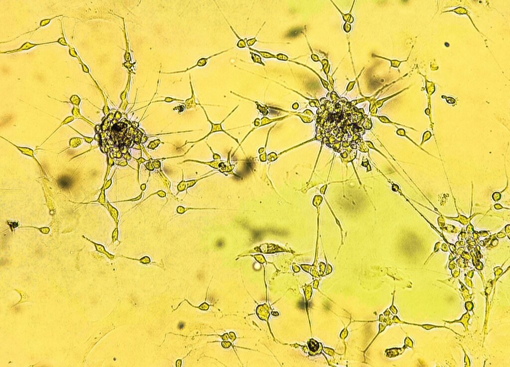 Cannabis compounds may weaken glioblastoma response to chemotherapy and radiation Cannabis compounds may weaken glioblastoma response to chemotherapy and radiation