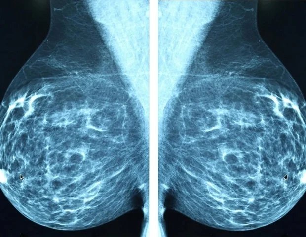 Digital care app improves quality of life for breast cancer patients Digital care app improves quality of life for breast cancer patients