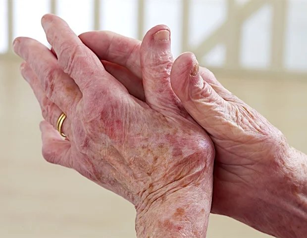 EuroSpA study links country income to arthritis treatment outcomes EuroSpA study links country income to arthritis treatment outcomes