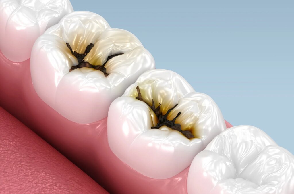Large US trial supports silver diamine fluoride for severe early childhood caries