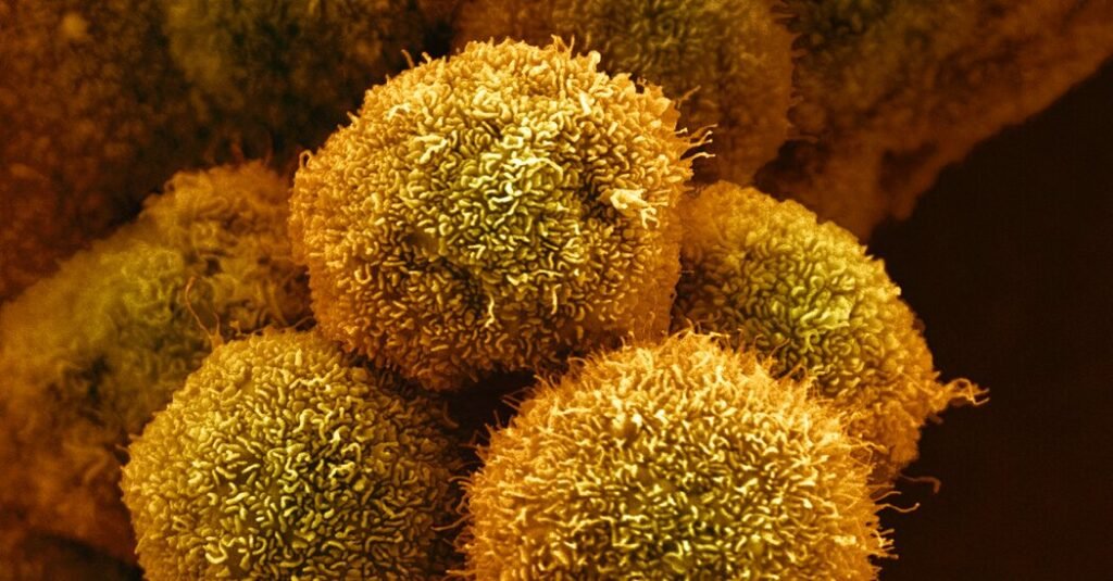 New Drug Approved by F.D.A. for Pancreatic Cancer Could Be First of Many New Drug Approved by F.D.A. for Pancreatic Cancer Could Be First of Many