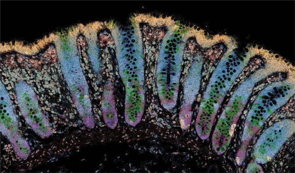 Researchers identify early molecular warning signs of inflammatory bowel disease