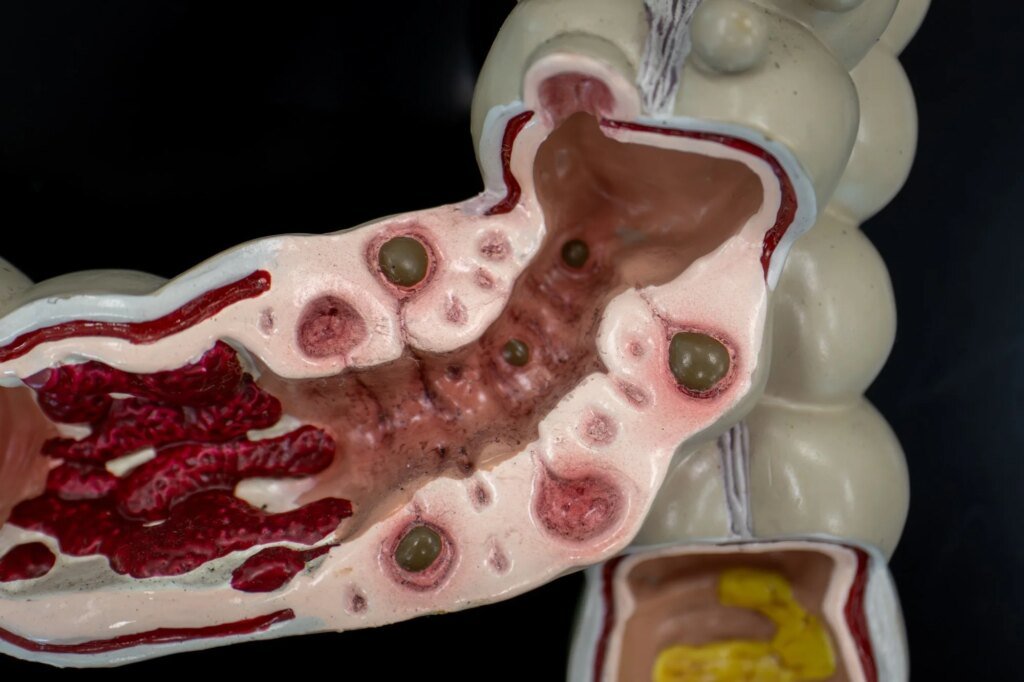 Scientists found a distinct gut microbiome pattern in people with symptomatic diverticular disease Scientists found a distinct gut microbiome pattern in people with symptomatic diverticular disease