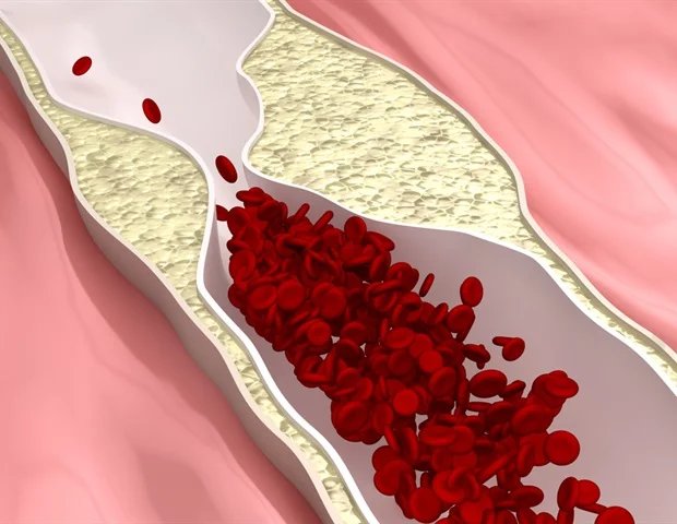 Atherosclerosis qualifies as an autoimmune disease Atherosclerosis qualifies as an autoimmune disease