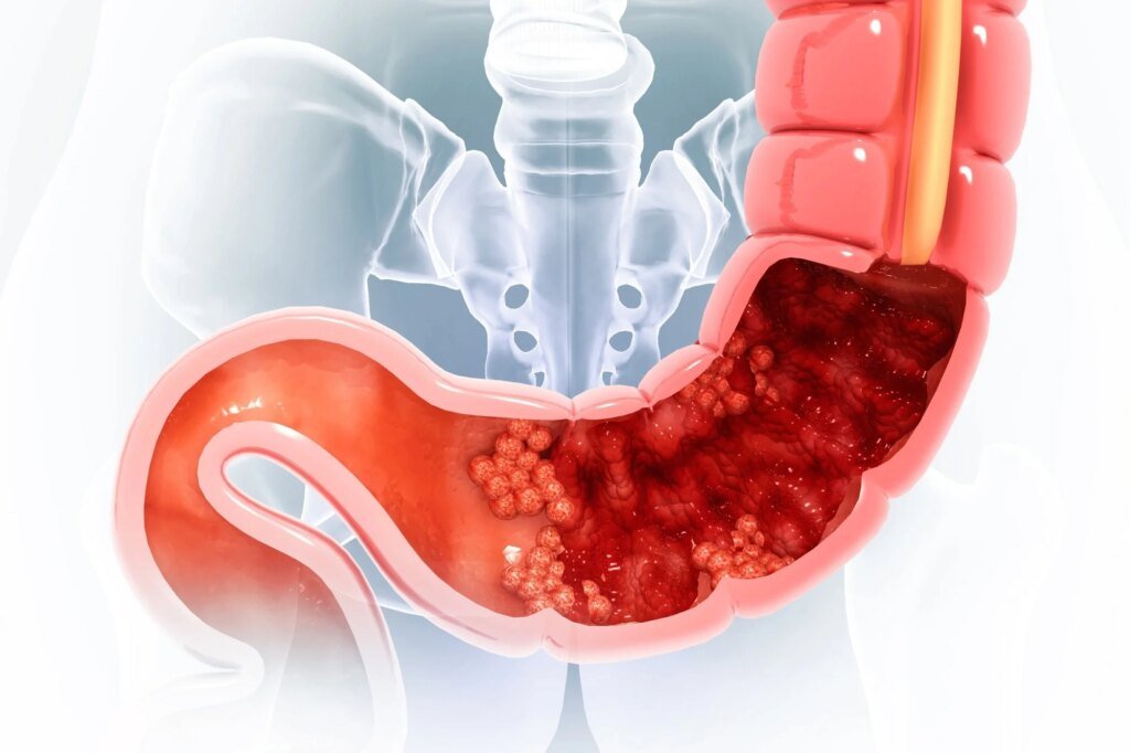 Coffee after colorectal cancer? Decaf and caffeine show different links with mortality