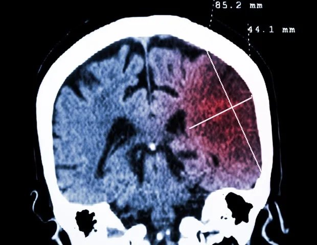 Genetic variant accelerates Huntington’s disease onset by over a decade Genetic variant accelerates Huntington’s disease onset by over a decade