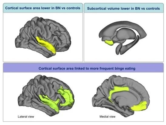Largest neuroimaging study of bulimia nervosa finds structural brain differences linked to diagnosis and binge-eating severity Largest neuroimaging study of bulimia nervosa finds structural brain differences linked to diagnosis and binge-eating severity
