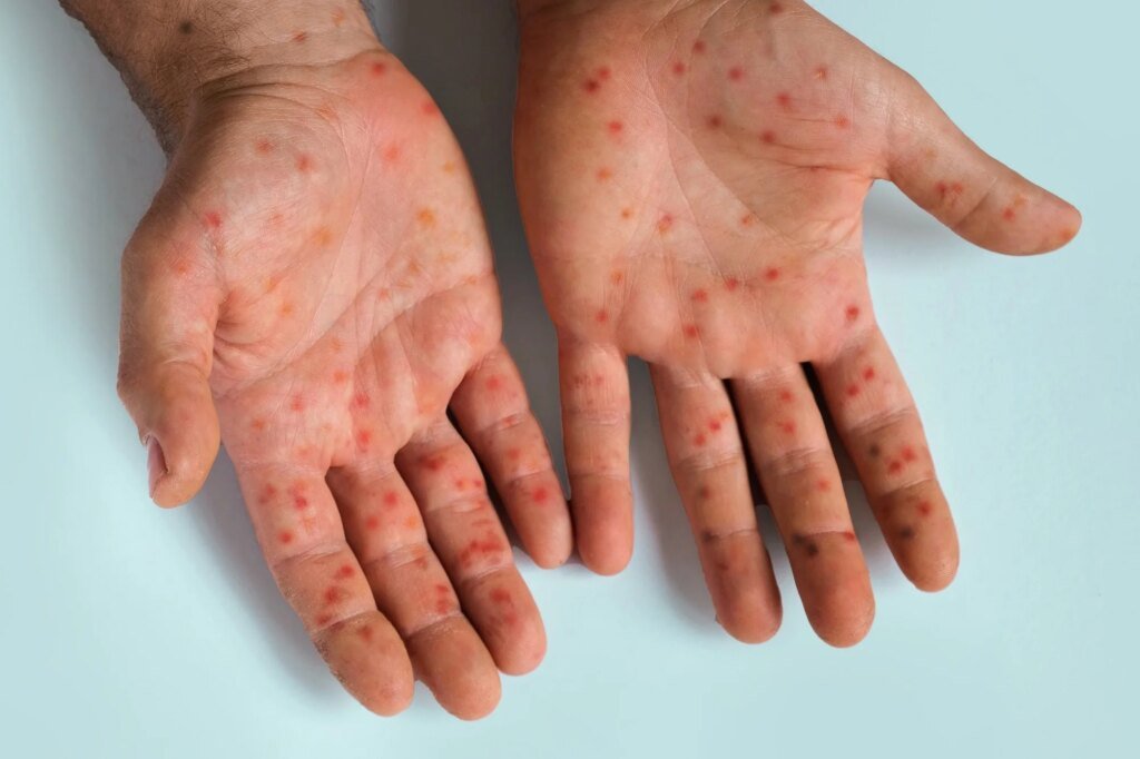 Measles outbreaks may reveal more than gaps in vaccination Measles outbreaks may reveal more than gaps in vaccination