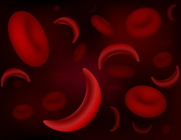 NIH grant funds research on environmental triggers for sickle cell disease NIH grant funds research on environmental triggers for sickle cell disease