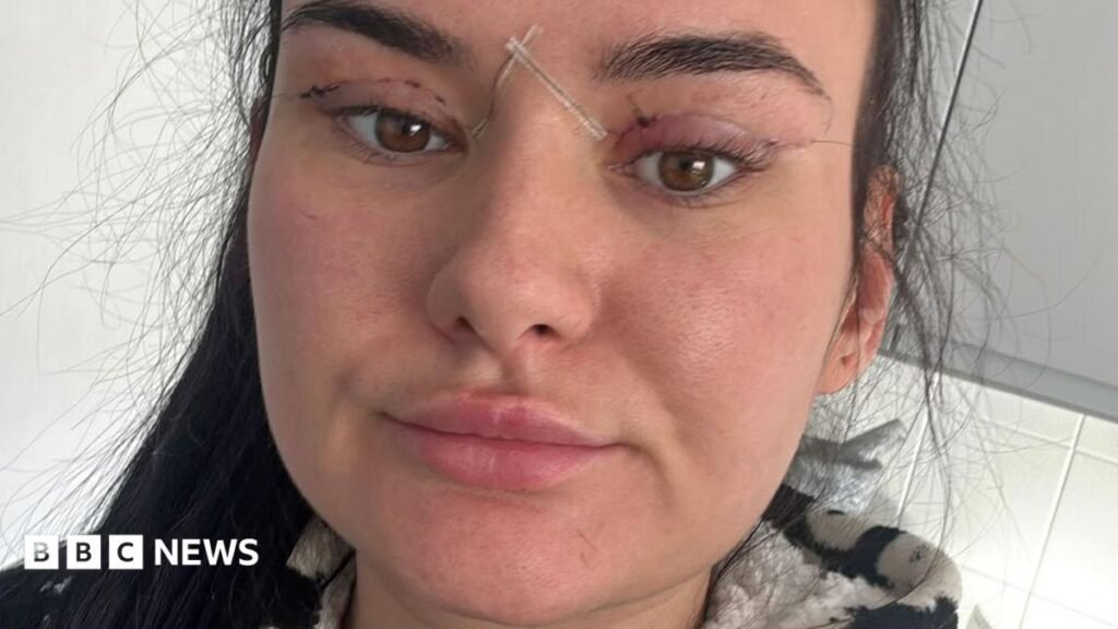 Open wounds and eyes that can’t close – women warn about cheap bleph eyelid surgery