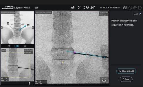 Siemens Healthineers Software For Trackerless Spinal Surgery Siemens Healthineers Software For Trackerless Spinal Surgery