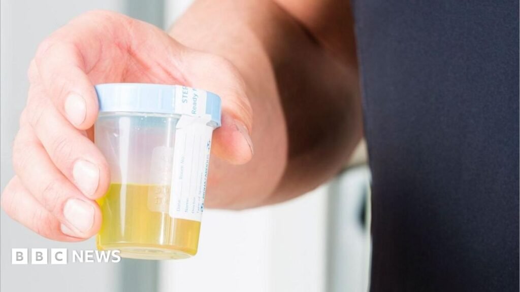 Urine test can spot more than nine in 10 bladder cancers