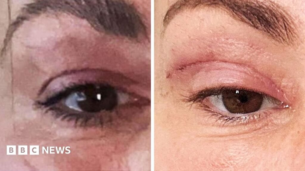 Watch: ‘My eyelids became infected – I was scared to sleep’ Watch: ‘My eyelids became infected – I was scared to sleep’