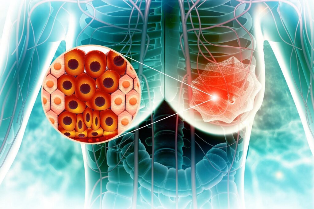 Why might a higher BMI at 20 be linked to lower breast cancer risk later in life? Why might a higher BMI at 20 be linked to lower breast cancer risk later in life?