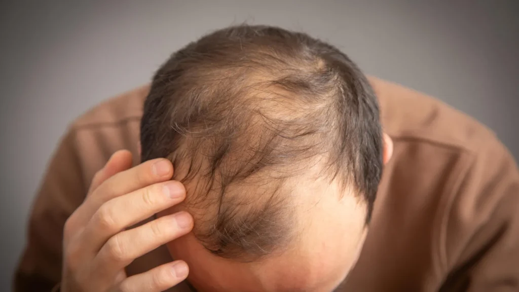 Ozempic and Wegovy may raise hair loss risk in some men Ozempic and Wegovy may raise hair loss risk in some men
