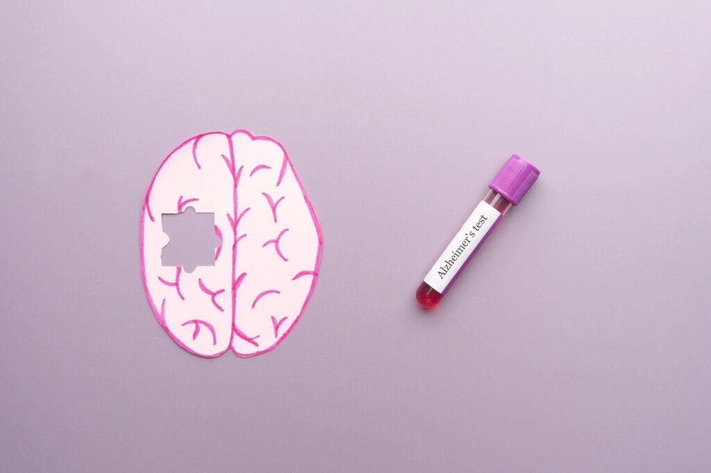 A study links a blood protein to memory and brain changes in Down syndrome