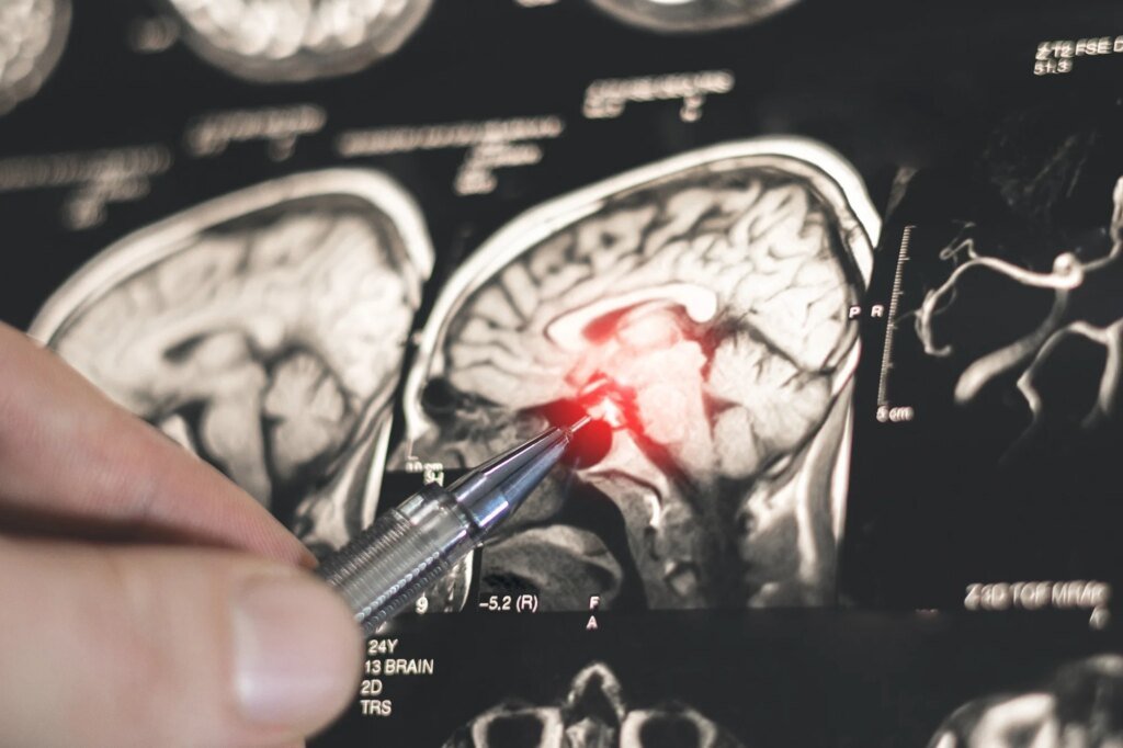 AI helps neurologists distinguish epilepsy from functional seizures