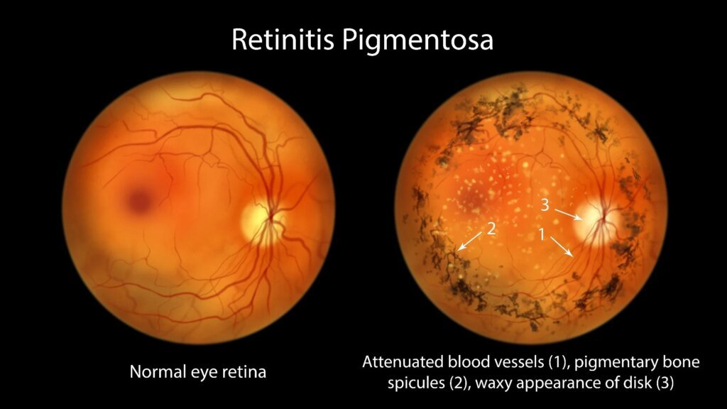 Gene therapy and special goggles help some blind adults detect objects again
