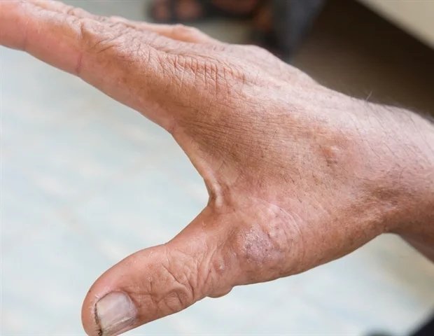 New imaging technique detects subtle skin changes in scleroderma patients New imaging technique detects subtle skin changes in scleroderma patients