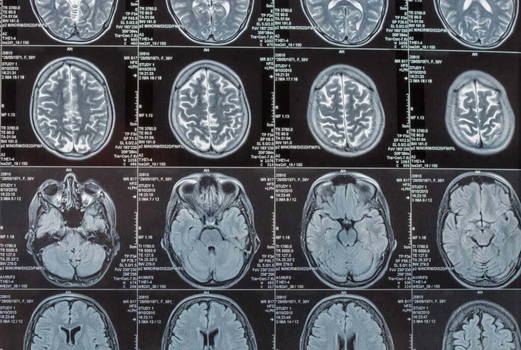 What can 6,000 brain scans tell us about Alzheimer’s?